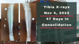 Height Journey - Tibia X-rays 47 Days In Consolidation