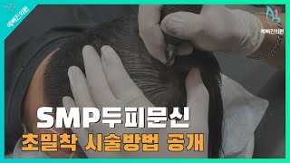 SMP 두피문신 초밀착 시술방법 공개!