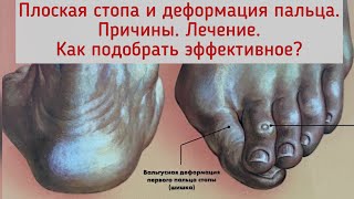 Поперечное плоскостопие, косточка на стопе. Причины. Как самому выбрать подходящее лечение.