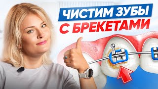 Как ухаживать за зубами с брекетами! 6 важных правил