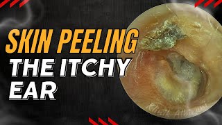 Skin Peeling The Itchy Ear