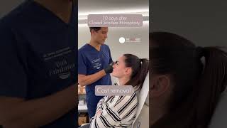 Cast removal - Natural look after Closed Scarless Rhinoplasty | Dr. med. Simon Zimmermann