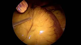 IFABond for closing Petersen's space hernia in a Gastric Bypass Feb 18 Mr Ahmed