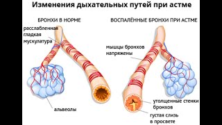 Бронхиальная астма, Тяньши, емделу жолдары