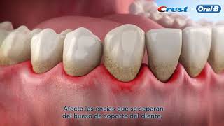 ENFERMEDAD PERIODONTAL - ORAL B