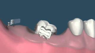 Distalização de molar com mini implante