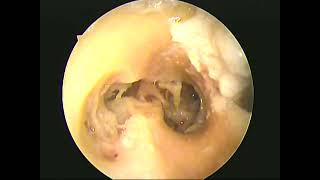 Temporal bone dissection endoscopic two handed part2(unedited)- dr.shreekantha acharya