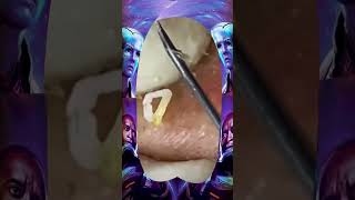 Blackheads Removal | Acne Treatment and Very Satisfying Satisfying Pimple pop #blackheads #skincare