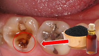 HOW TO RELIEVE TOOTHACHE AND DENTAL INFECTIONS NATURALLY