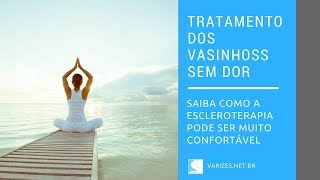 Escleroterapia ou secagem de veias sem dor.