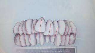 simulazione ortodontica virtuale invisalign