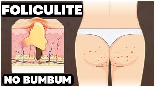 COMO ACABAR COM A FOLICULITE NO BUMBUM [SOLUÇÃO FÁCIL]