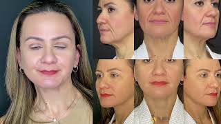 50-Year-Old Patient, recent Lower Face & Neck lift. South Florida Face Life by Doctor Shashi Kusuma.