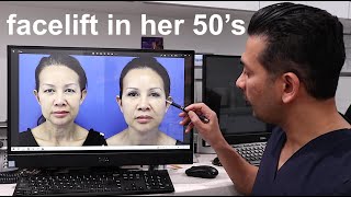 Facelift In Her 50's - Dr. Dass Beverly Hiils Shows Before and After