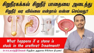 Struck Urethral Calculus treatment? கல் சிறுநீர்பாதையை அடைத்து சிறுநீர் வர வில்லை என்றால் தீர்வு ?