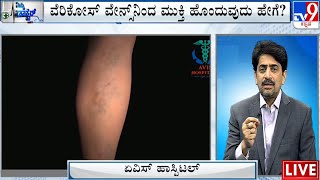 Nimma Doctor | Treatment For Varicose Veins | AVIS Hospital (22-11-2023)