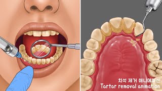 ASMR 아~주 오래된 치석제거 애니메이션 part1 | 스케일링 | Very heavy tartar removal animation | Calculus cleaning