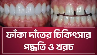 মাত্র ১ দিনে ফাঁকা দাঁতের চিকিৎসার খরচ ও বিস্তারিত তথ্য । Tech Dental