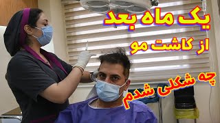 کاشت مو و سوالات متداول👈🏻تجربیات من  👉🏻