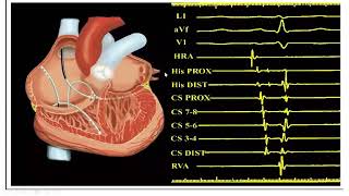 Introduction into intracardiac tracing part -1