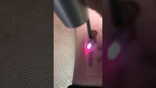 Laser tattoo removal using Describe patch