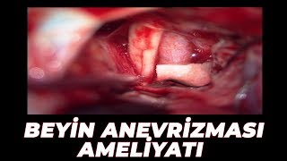 Beyin Anevrizması Ameliyatı - Kanamış Sağ Acom Anevrizma