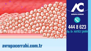 Genital Siğil (Hpv) Nedir ?