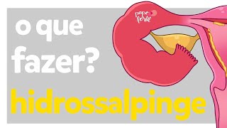 Hidrossalpinge, o que fazer? | Dra Letícia | Papo Fértil