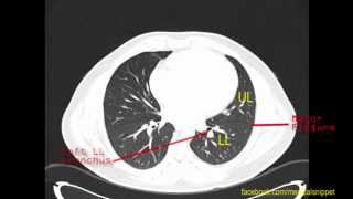 CT anatomy of Left Lung