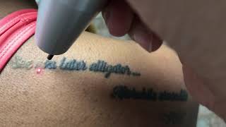 See you later alligator shoulder tattoo laser Removal