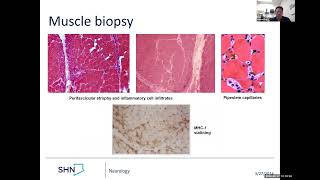 Dermatomyositis   clinical case and treatment