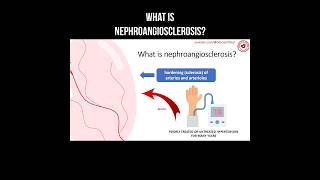 What is nephroangiosclerosis? #kidneydisease #nephroangiosclerosis #kidneyhealth #kidney