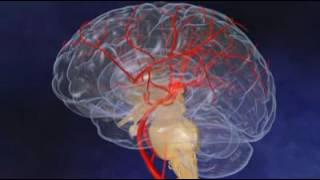 L #039;accident vasculaire cérébral ou AVC en vidéo, e sante fr   E santé