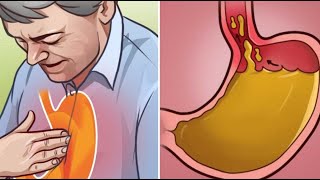 Apprenez à éliminer les brûlures d’estomac et les reflux acides avec des remèdes naturels