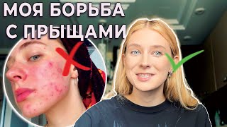 КАК ВЫЛЕЧИТЬ ПРЫЩИ | ЗДОРОВАЯ КОЖА ЛИЦА