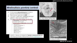 Síndrome de desmielinización osmótica #neurologia #neurology  #medicina #medicine #hospital