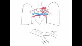 Hemoptysis (coughing blood) diagnostic work up