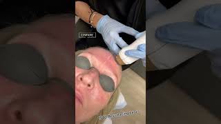 Resurfacing Laser at University Park Dermatology & Medical Spa