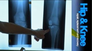 Knee Replacement Surgery: Knee School