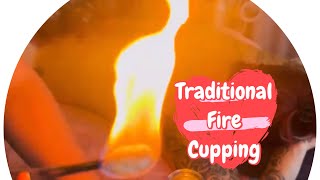 Have you heard of traditional fire cupping?