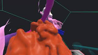 #326 Parametrial endometriosis-2Step excision with VR reconstruction- Dr. Rooma Sinha