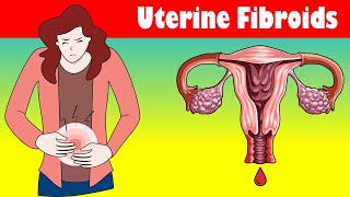 Uterine Fibroids Signs And Symptoms Types, Causes, And Treatment