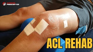 ACL tear rehab