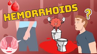 Hemorrhoids :- Types, Causes, Risk Factors, Signs & Symptoms, Diagnosis, & Treatment