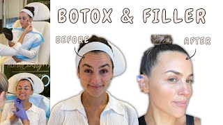 BOTOX BEFORE AND AFTER