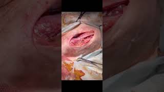 Subcutaneous ureteral bypass ( Установка SUB системы при обструкции мочеточников(