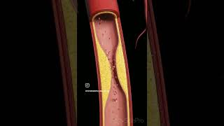 Atherosclerosis #viralreels #anatomy #biology #physiotharapist #exercise #doctor#science