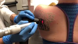 Laser tattoo removal on a black back tattoo