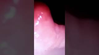 192.oesophagoscopy #technique of rigid esophagoscopy #swallowing #dysphagia #surgeryeducation