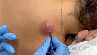 Draining the infected cyst of a pregnant patient